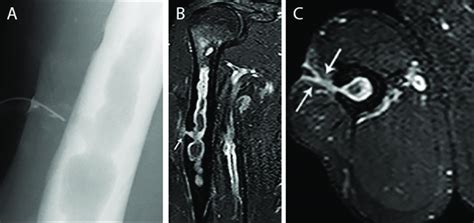 Chronic Osteomyelitis Of The Right Humerus With Fistula Formation