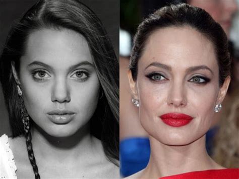 What Kind Of Cosmetic Procedure Did Angelina Jolie Go For Quora