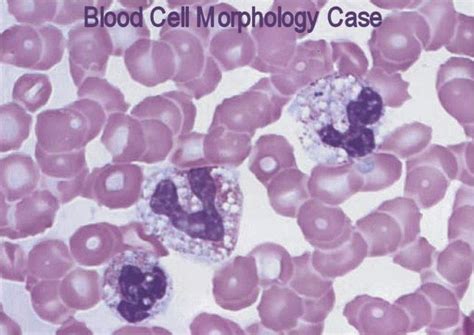 Leukocyte Morphology Case What Can You Say About These Leukocytes