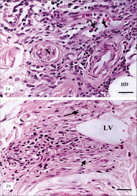 A Erythema Nodosum Leprosum In A Bl Patient Note The Mononuclear