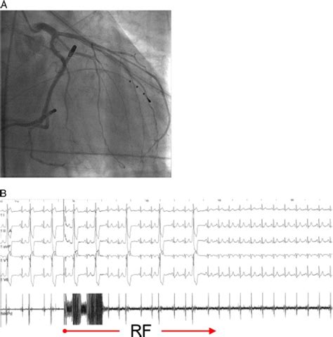 Idiopathic Ventricular Outflow Tract Arrhythmias From The Great Cardiac