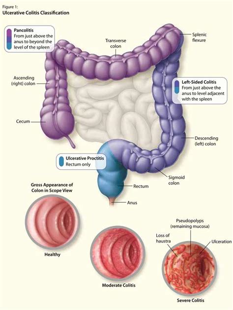 The Patient With Newly Diagnosed Ulcerative Colitis HealthPlexus Net