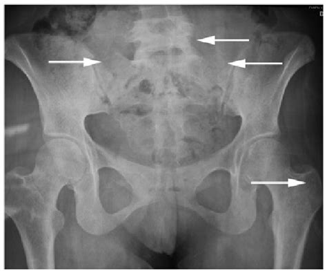 Male pelvis anatomy diagram / 94 best anatomy and. Pelvic X-ray film revealing a bone lesion (white arrows ...
