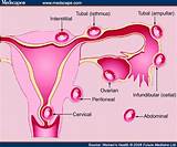 Cervical Ectopic Pregnancy Treatment Photos