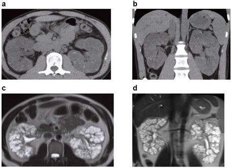 Jcm Free Full Text Cystic Kidney Diseases That Require A