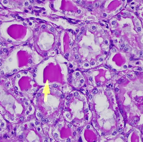 Left Renal Tubules Showing Hyaline Cast Arrow In S