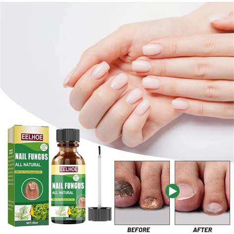 EELHOE Onychomycosis Fungus Repair Liquid Toenail Tea Tree Oil Refers