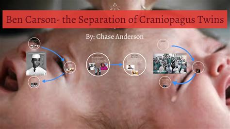 Ben Carson The Separation Of Craniopagus Twins By Chase Anderson