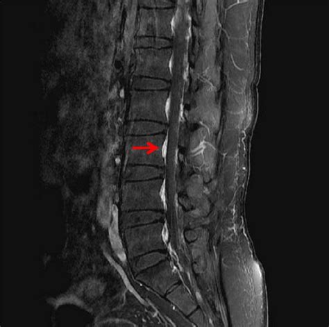Lumbar Spine M Ri With Postcontrast Fat Suppressed T1 Weighted Sagittal