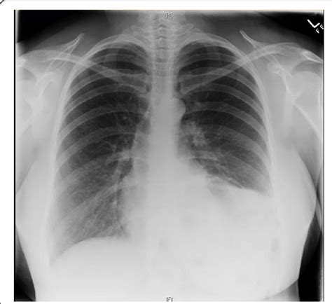 Chest Xray From First Presentation At 13 Weeks Showing Left Lower Lobe