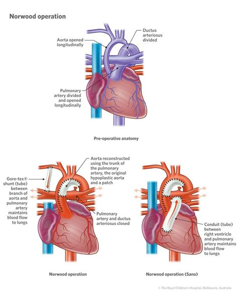 Cardiology Hypoplastic Left Heart Syndrome Hd Cardiology Nurse