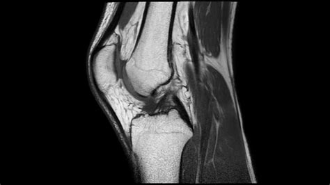 Mri Of A Normal Knee Youtube