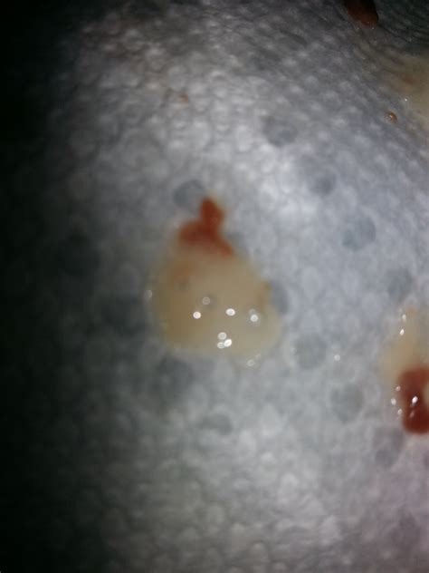 A tumor due to primary lung cancer, or cancer which has spread to the lungs, is. Phlegm In Baby S Throat - Best Voyeur Porn