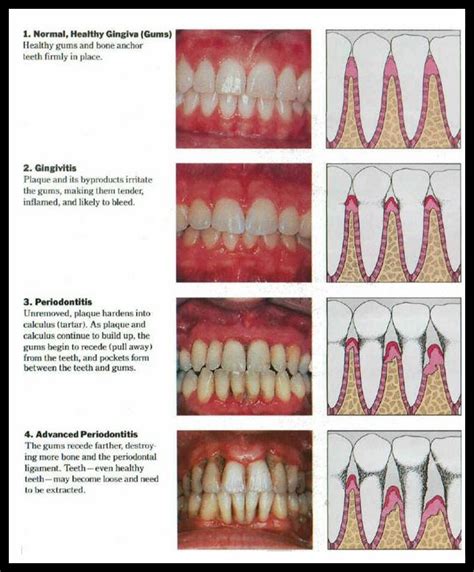 Diagram Showing The Progression Of Gum Disease Periodontal Disease