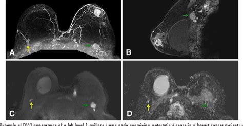 Figure 8 From Imaging Axillary Lymph Nodes In Patients With Newly
