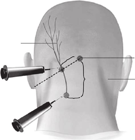 Protuberância Occipital Externa Aumentada