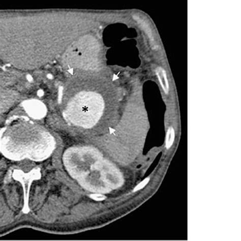 Contrast Enhanced Ct Scan Showing A Pancreatic Pseudocyst With A