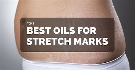 Top 5 Best Oils For Stretch Marks Reviews 2022