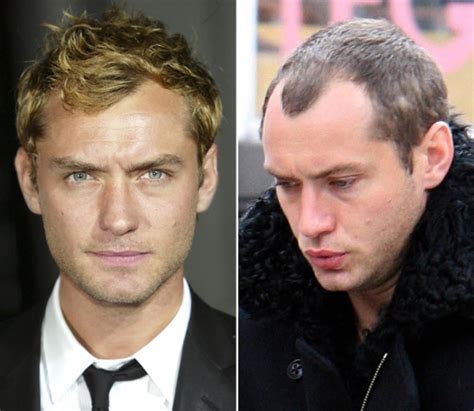 Celebrity Hair Loss Before And Pictures Bald