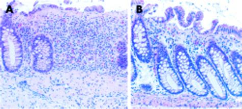 Budesonide Treatment Of Collagenous Colitis A Randomised Double Blind