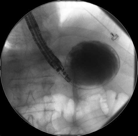 Eus Directed Transgastric Ercp For Roux En Y Gastric Bypass Anatomy A