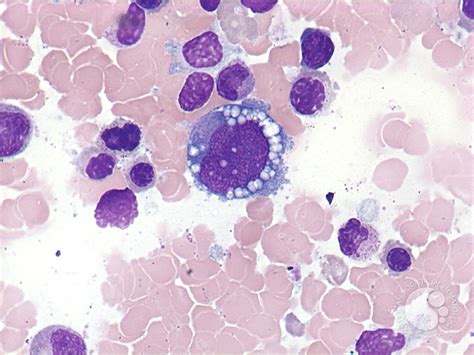 Anaplastic Large Cell Lymphoma Bone Marrow Aspirate 3