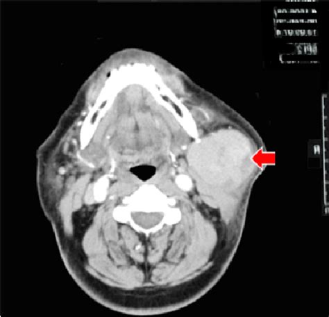 Contrast Ct Scan Of Neck Lymph Nodes Ct Scan Machine