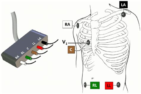 5 Lead Ecg Placement