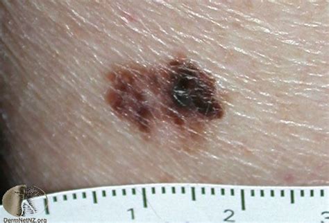 Deadly Skin Cancers