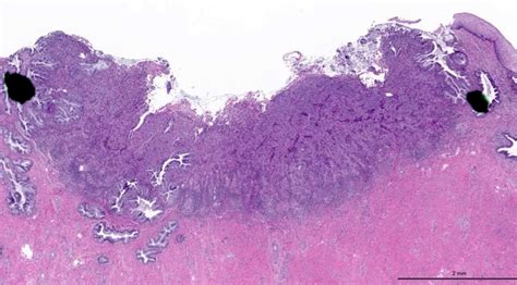 Pathology Outlines Hpv Associated Cervical Squamous Cell Carcinoma