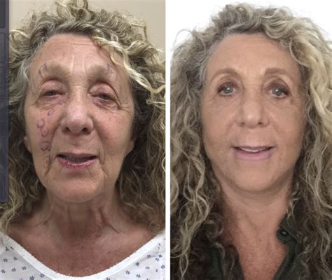 The Hourlift Mini Face Lifts Look 10 Years Younger