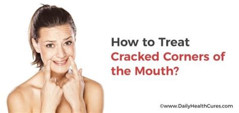 Cracked Corners Of Mouth Angular Cheilitis 6 Causes And Treatments