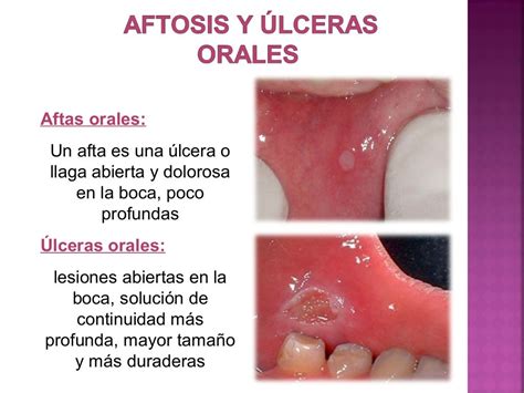 Lesiones De La Cavidad Oral