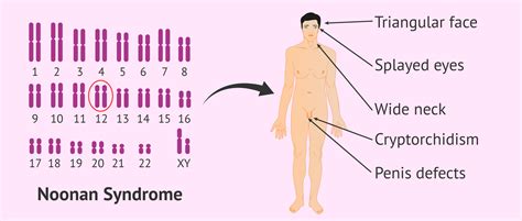 Characteristics Of Noonan Syndrome