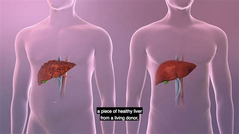 Upmc Living Donor Liver Transplant Youtube