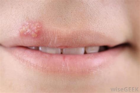 Clear Blister On Inside Of Lip Pictures Photos