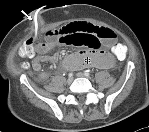 Follow The Stream Imaging Of Urinary Diversions Radiographics