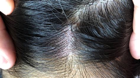 How To Tell If You Have Seborrheic Dermatitis Or Dandruff