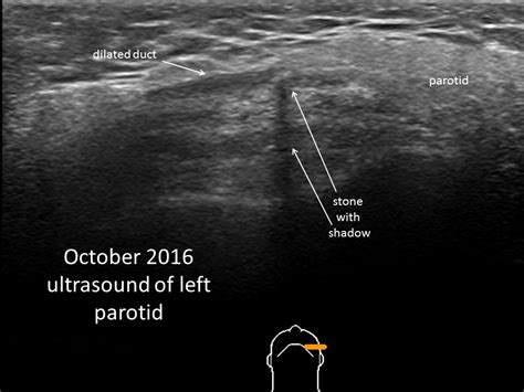 Parotid Gland Duct Ultrasound