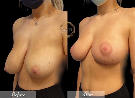 How Long After Bbl Can I Get Breast Augmentation Qazi Clinic