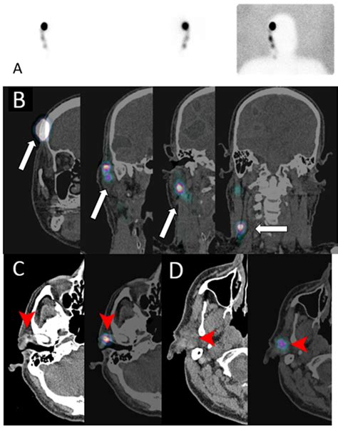 Cancers Free Full Text Oncologic Imaging Of The Lymphatic System