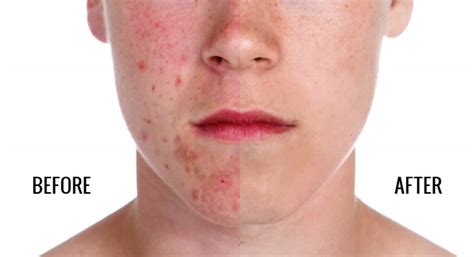 Technique For Removing Acne In Photoshop