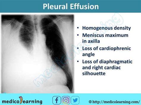 An X Ray Image With The Words Pleural Effusion On It