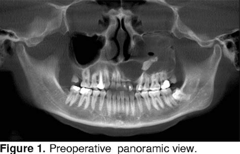 Dentigerous Cyst With An Impacted Canine Case Report Semantic Scholar