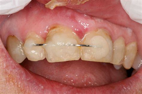 And broken and dislodged teeth. Tooth Subluxation Case Study - Cape Dental Care