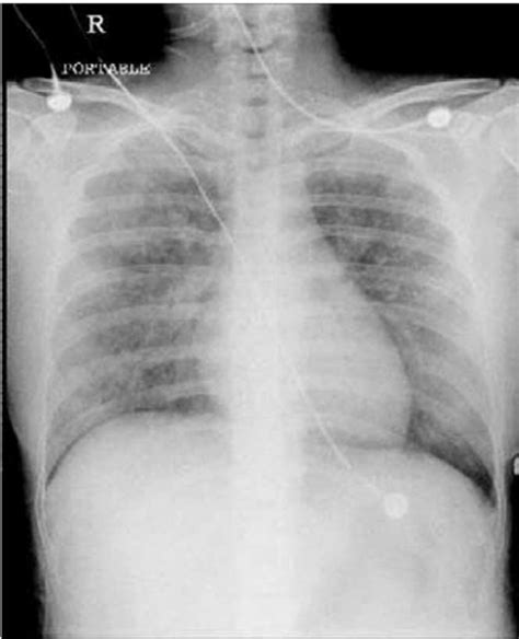 Case 2 Chest Radiograph Showing Pulmonary Edema Download Scientific