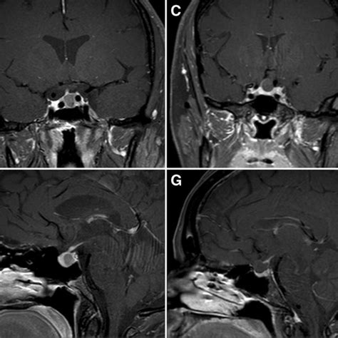 Coronal And Sagittal Pituitary Protocol Mri Images Of A B