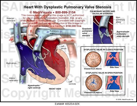 Heart With Dysplastic Pulmonary Valve Stenosis Medical Illustration