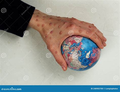 Blistering Rash On Womanand X27s Hand Holding Globe Stock Photo Image