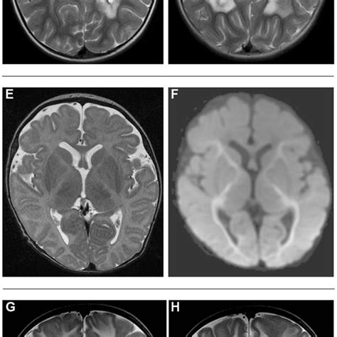Brain Mri Studies In Nfu1 Mutant Patients 2 T2 Weighted Axial Scans At